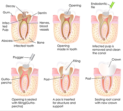 Root Canal in Bradley