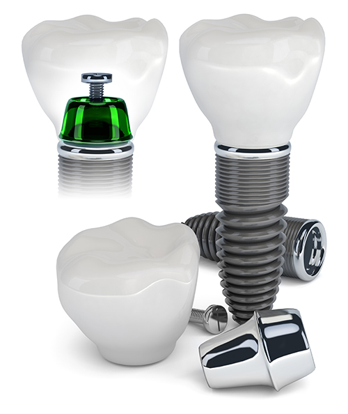 Dental Implants 60914