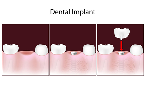 Dental Implants in Bradley